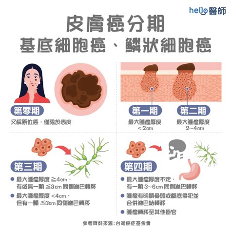 皮膚癌|皮膚癌分期治療方式？皮膚癌照片、治療費用、治癒率一次看